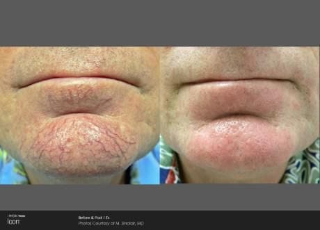 Before and after ICON laser treatment: broken facial veins around the chin cleared