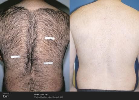 Before and after ICON laser hair removal: dense back hair permanently removed