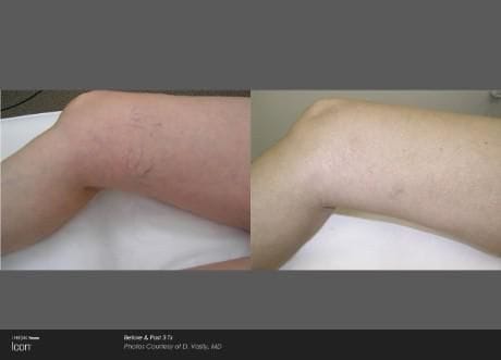 Before and after ICON laser treatment: spider veins on a leg visibly cleared