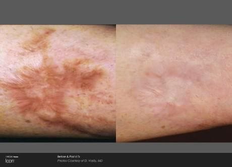 Before and after ICON laser treatment: raised scarring and discoloration on skin smoothed and faded
