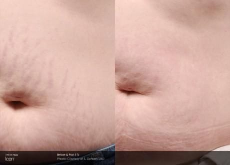 Before and after ICON laser treatment: stretch marks on an abdomen visibly reduced