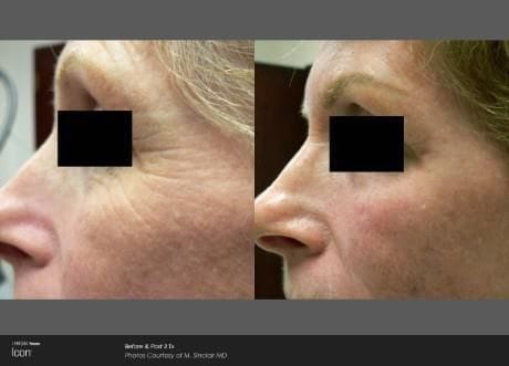 Before and after ICON laser treatment: crow’s feet wrinkles around an eye visibly smoothed